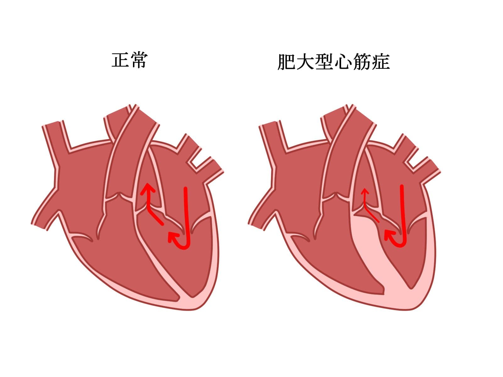 正常な心臓と肥大型心筋症の違い
